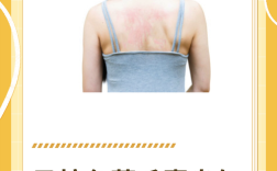 马8 马拉色菌毛囊炎怎样彻底消除