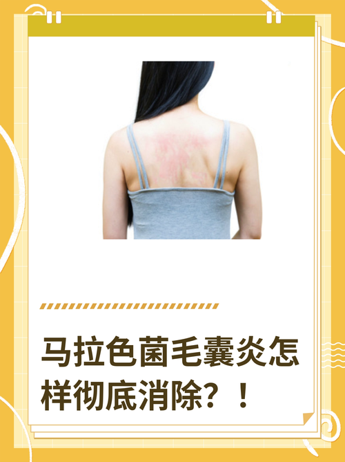 马8 马拉色菌毛囊炎怎样彻底消除